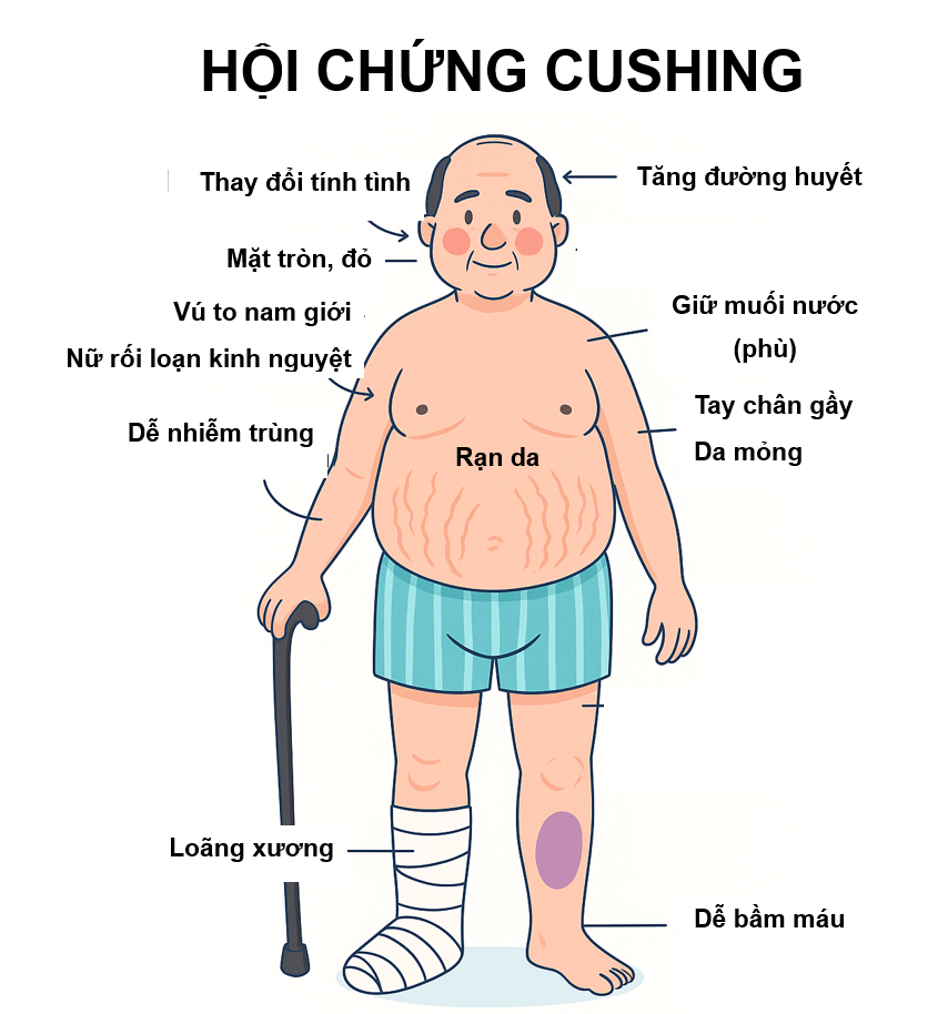 hội chứng Cushing.PNG